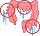 colon dilation